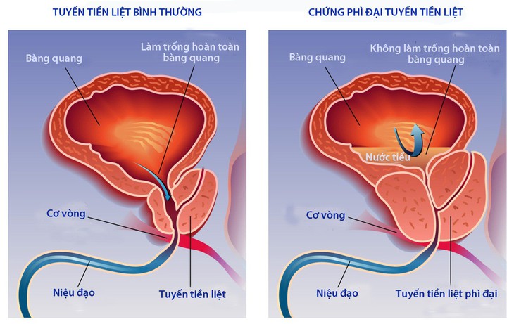 Ảnh hưởng của điều trị phì đại tiền liệt tuyến lành tính đến khả năng tình dục - Ảnh 1.