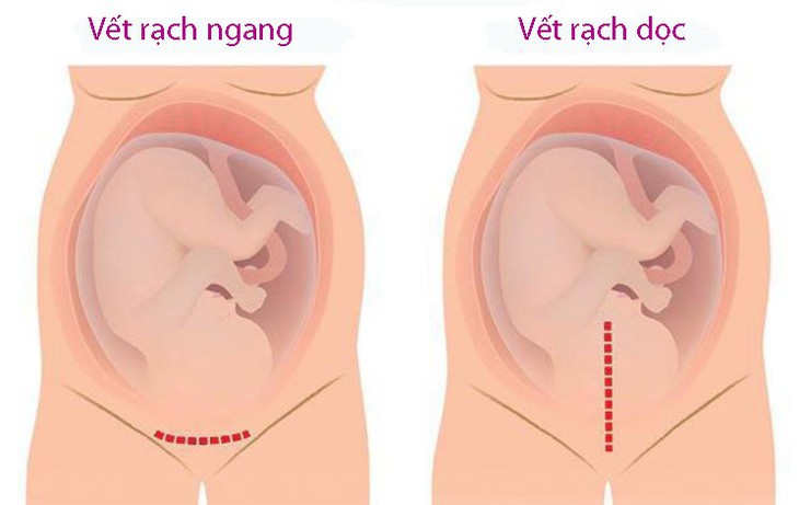 Những câu hỏi thường gặp về sẹo mổ đẻ - Ảnh 1.