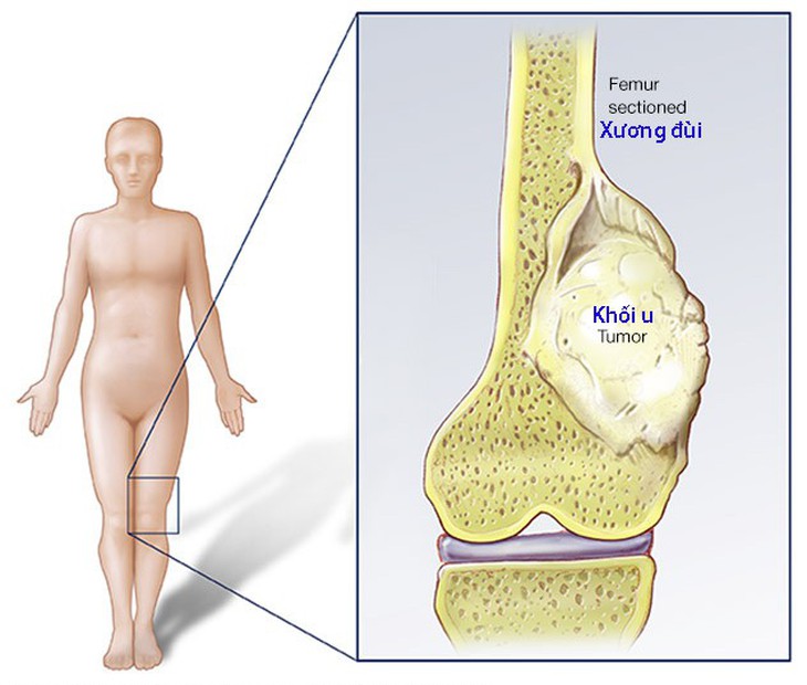 Ung thư xương và đau - Ảnh 1.