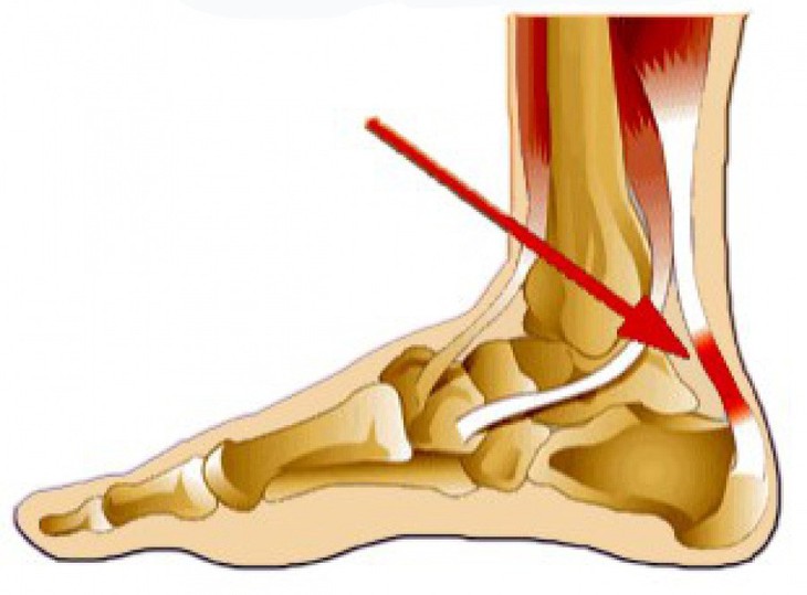 Đau gót chân (heel pain) - Ảnh 1.