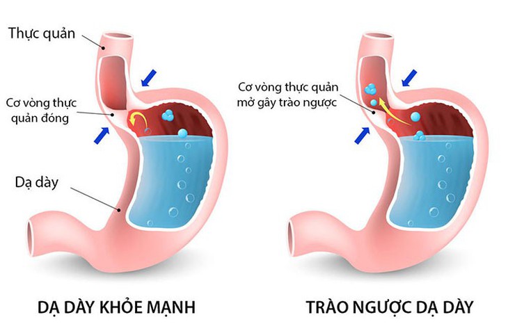 Cẩn thận với bệnh trào ngược dạ dày, thực quản - Ảnh 1.