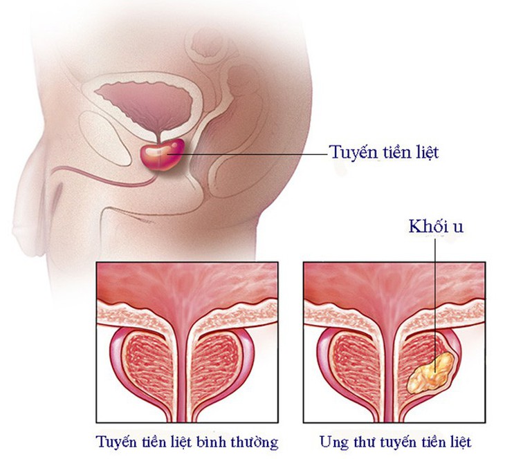 5 lầm tưởng thường gặp về ung thư tuyến tiền liệt - Ảnh 1.