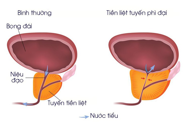 Phì đại tiền liệt tuyến - Ảnh 1.