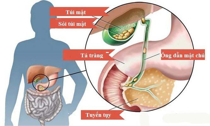 Cách phòng ngừa sỏi túi mật - Ảnh 1.