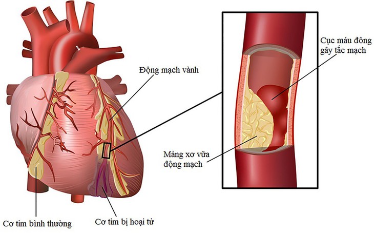 Rối loạn lipid máu và cách phòng ngừa - Ảnh 1.