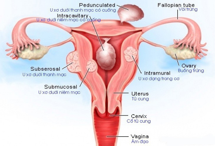 U xơ tử cung ở phụ nữ độc thân - Ảnh 1.