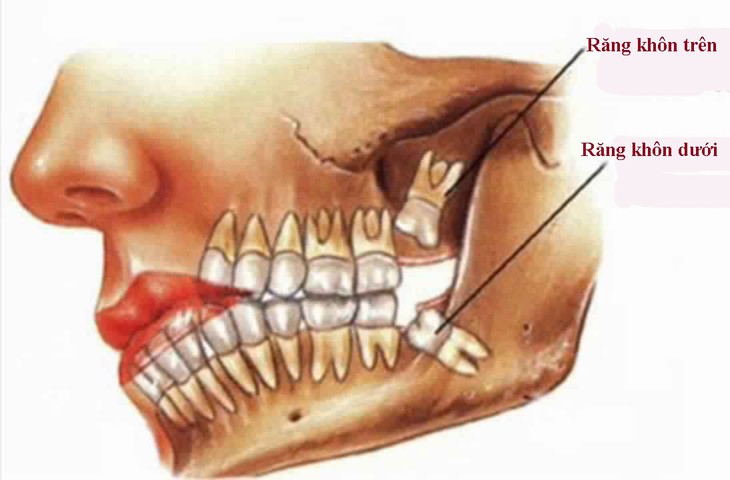 Nhổ răng khôn - Ảnh 1.