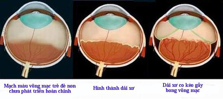 Giúp trẻ sinh non thoát khỏi nguy cơ mù lòa - Ảnh 1.