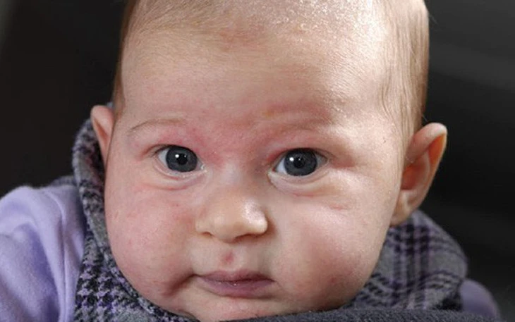 Bệnh nhi 3 tháng tuổi bị sốc phản vệ nặng sau khi uống sữa công thức - Ảnh 2.