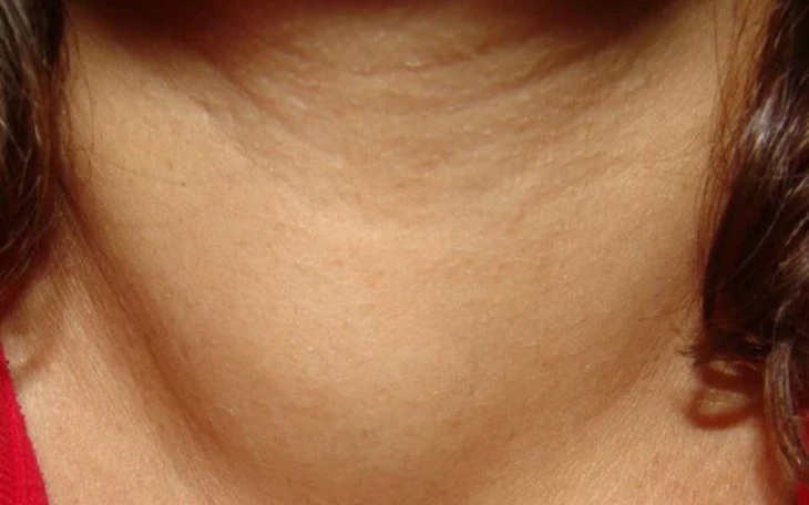 Viêm tuyến giáp có thể ảnh hưởng tim mạch, sinh sản nếu không điều trị sớm - Ảnh 2.