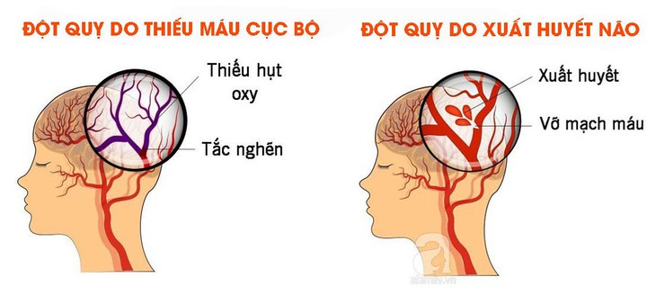 Chứng đột quỵ ở người cao tuổi - Ảnh 1.