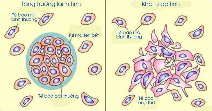 Phân biệt u lành và u ác - Ảnh 1.