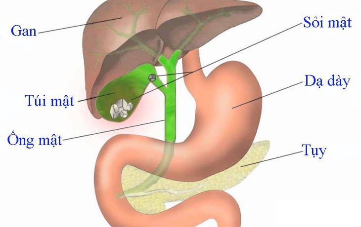 Những điều cần biết sau khi cắt túi mật - Ảnh 1.