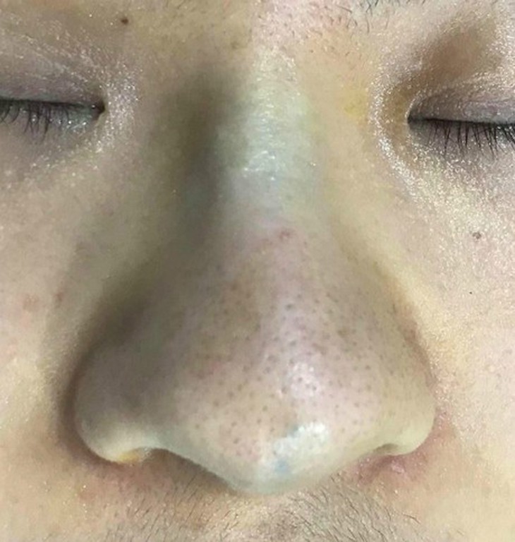 Gắp một búi chỉ từ... mũi nữ bệnh nhân đi làm đẹp - Ảnh 1.