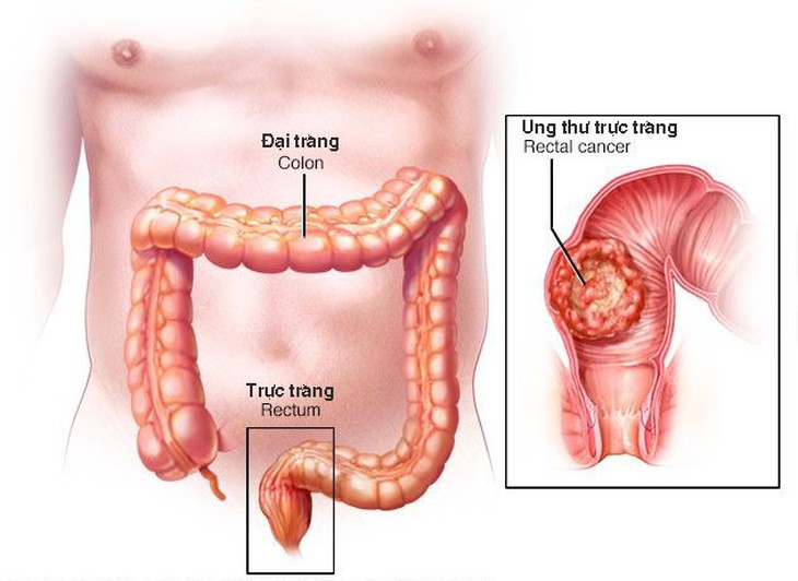 Ung thư trực tràng có chữa được không? - Ảnh 1.