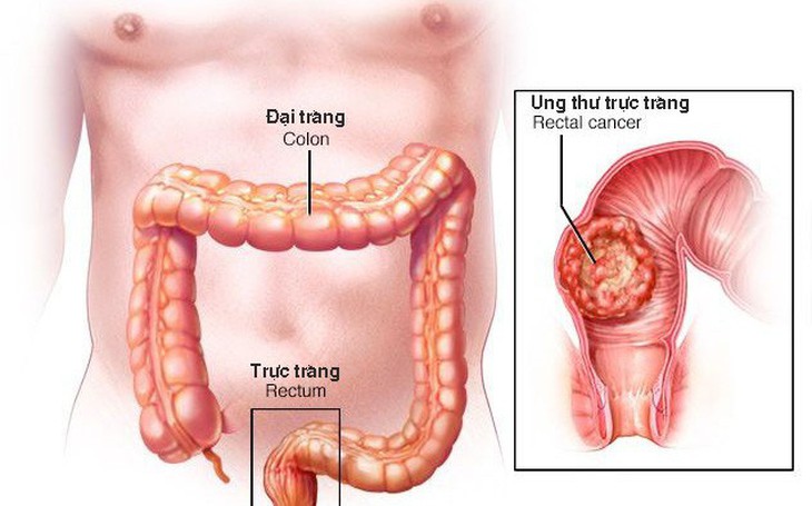 Ung thư trực tràng có chữa được không?