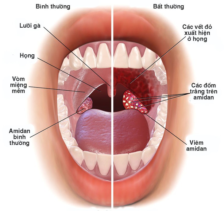 Mùa hè, viêm họng nhiều cơ hội tái phát - Ảnh 1.