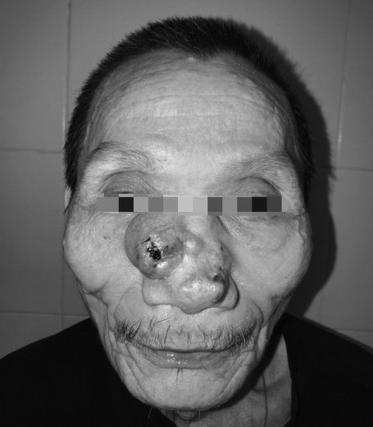 Tái tạo toàn bộ mũi và má cho bệnh nhân ung thư - Ảnh 1. Tái tạo toàn bộ mũi và má cho bệnh nhân ung thư - Ảnh 1.