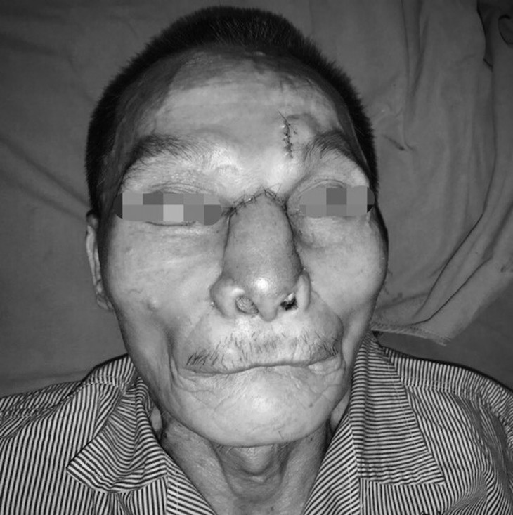 Tái tạo toàn bộ mũi và má cho bệnh nhân ung thư - Ảnh 2. Tái tạo toàn bộ mũi và má cho bệnh nhân ung thư - Ảnh 2.