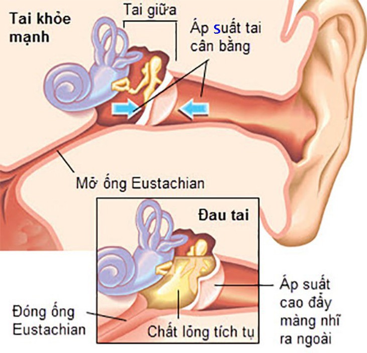 Viêm tai giữa “hàng không” - Ảnh 1.