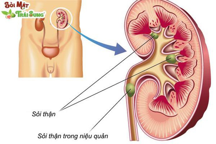 Điều trị sỏi thận, sỏi mật, sỏi gan theo xu hướng mới - Ảnh 1.