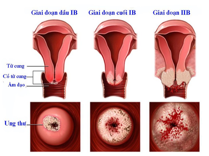 Dấu hiệu ung thư cổ tử cung - Ảnh 1.