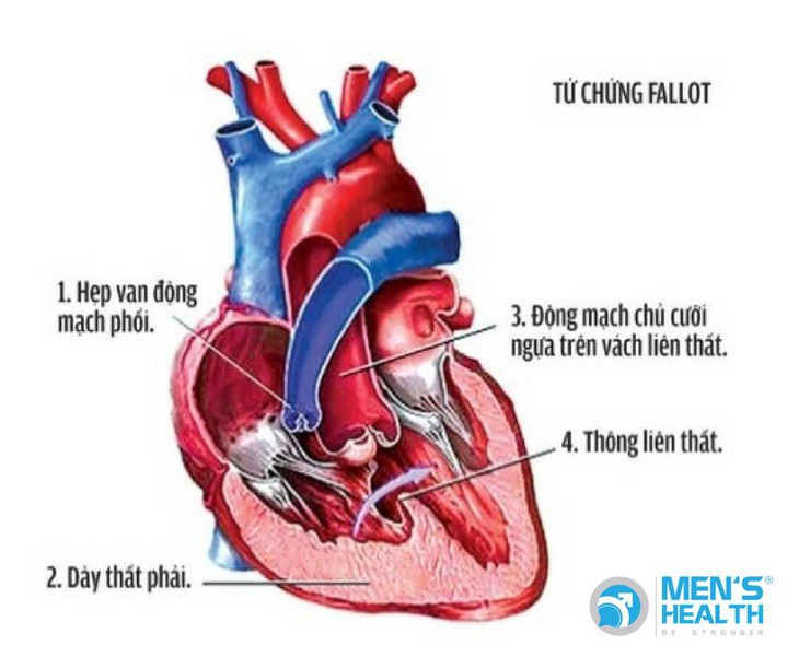 Biểu hiện thường gặp ở trẻ bị bệnh tim bẩm sinh và cách điều trị. - Ảnh 5.