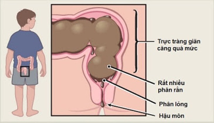 Giúp trẻ bỏ thói quen nhịn tiêu - Ảnh 1.