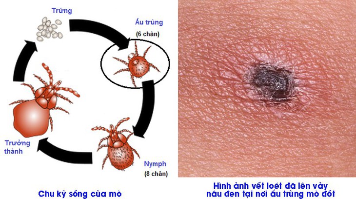 Bệnh sốt mò - phát hiện muộn dễ gây tử vong - Ảnh 1.