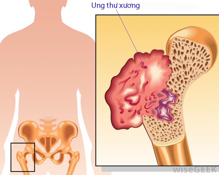 Phòng bệnh ung thư xương - Ảnh 1.