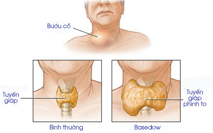 Những điều cần biết dành cho bệnh nhân Basedow - Ảnh 1.