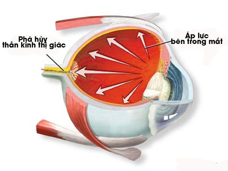 Không chủ quan với bệnh thiên đầu thống - Ảnh 1.