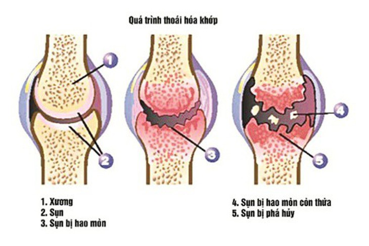 Ngừa thoái hóa khớp gối đúng cách - Ảnh 1.