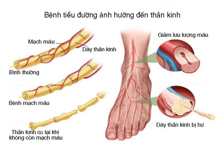 Bệnh thần kinh khu trú ở bệnh nhân đái tháo đường tuýp 2 - Ảnh 1.