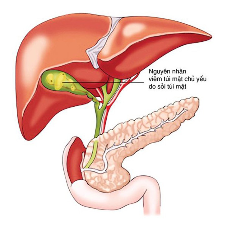 Cẩn thận với bệnh của túi mật - Ảnh 1.