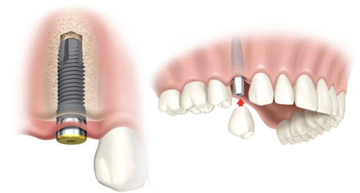 Ưu điểm răng Implant ETK Active của Nha Khoa Đông Nam - Ảnh 1.