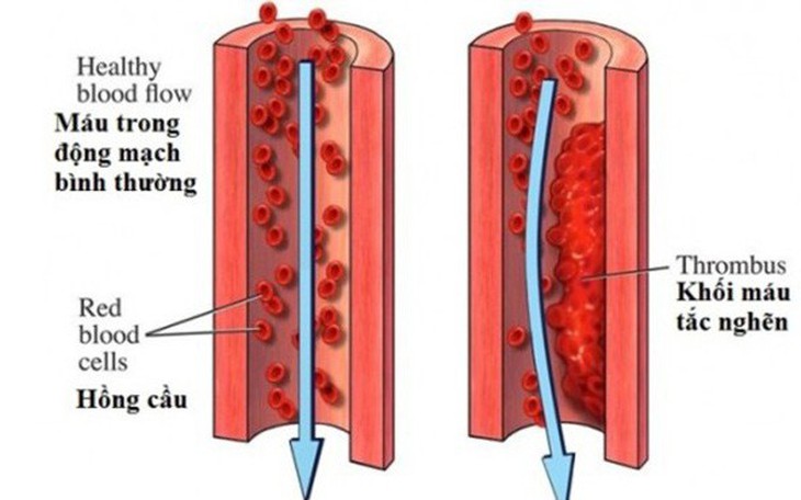 Bệnh viêm tắc động mạch