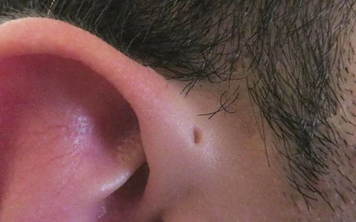 Gia đình 3 thế hệ cùng mắc bệnh rò luân nhĩ - Ảnh 2.