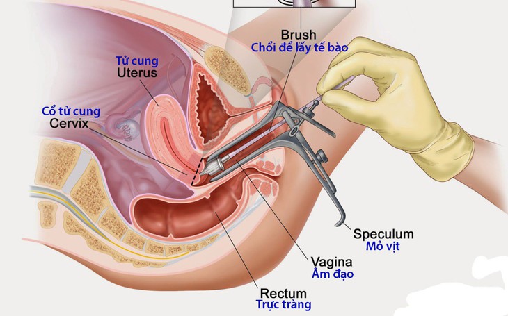 Phát hiện sớm ung thư cổ tử cung