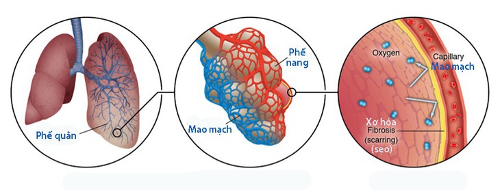 Xơ hóa phổi vô căn - Ảnh 1. Xơ hóa phổi vô căn - Ảnh 1.
