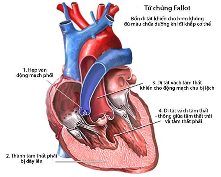 Các bệnh tim bẩm sinh thường gặp - Ảnh 1.