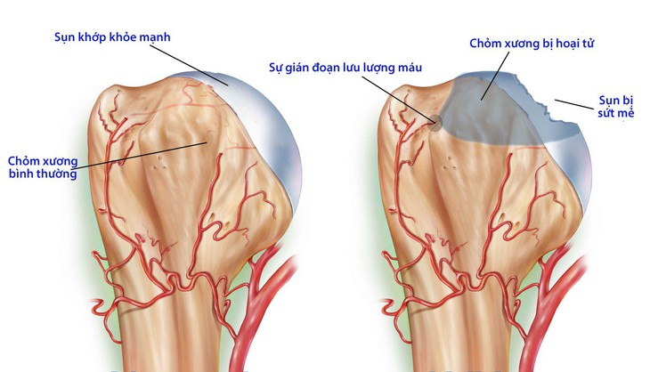 Hoại tử chỏm xương đùi do lạm dụng rượu bia, thuốc lá - Ảnh 1.