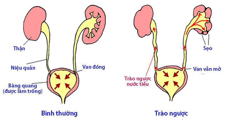 Bệnh trào ngược bàng quang - niệu quản ở trẻ em - Ảnh 1.