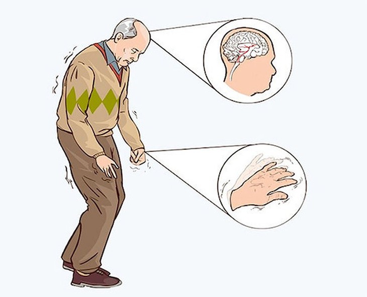 Bệnh Parkinson, người cao tuổi nên biết - Ảnh 1.