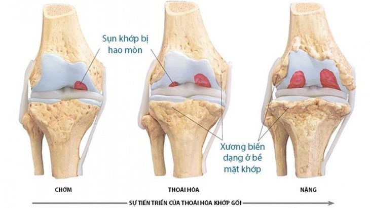 Giúp giảm đau, kháng viêm, ngừa thoái hóa sụn khớp với Crux - Ảnh 1.