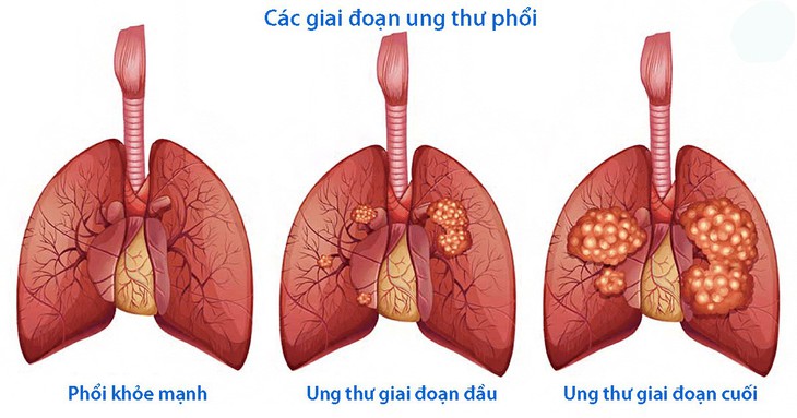 Điều trị ung thư phổi - Ảnh 1.