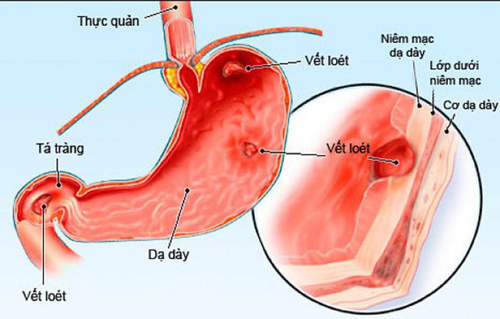 Những nguyên nhân hàng đầu gây bệnh sỏi thận - Ảnh 2.