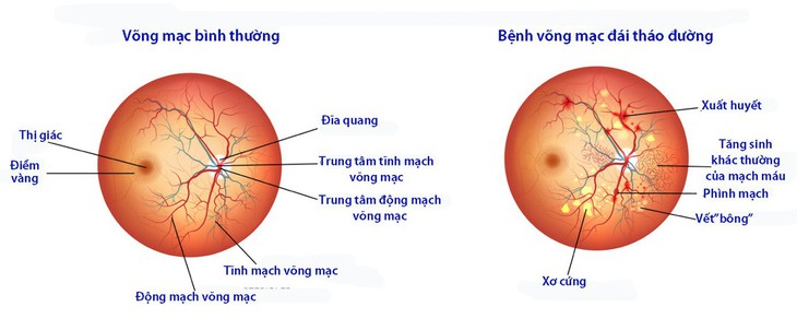 Bệnh đái tháo đường ảnh hưởng lên mắt như thế nào? - Ảnh 1.