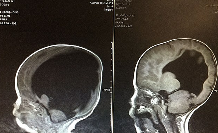 Sức sống kỳ diệu của cậu bé sinh ra ‘không có não’ - Ảnh 1.