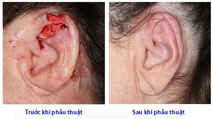 Bệnh ung thư tai - Ảnh 1. Bệnh ung thư tai - Ảnh 1.